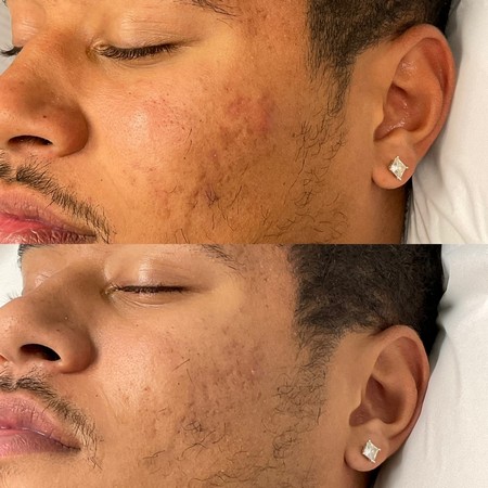 Microneedling: The Ideal Technique for Acne Scarring Treatment