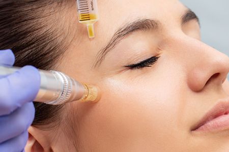 Fairlawn micro needling