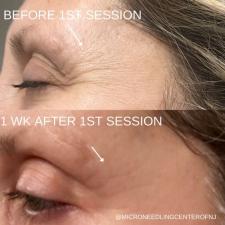 Before after microneedling 001