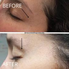 Before after microneedling 004