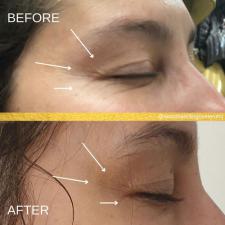 Before after microneedling 005