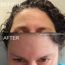 Before after microneedling 007