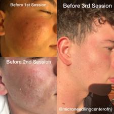 Before after microneedling 009