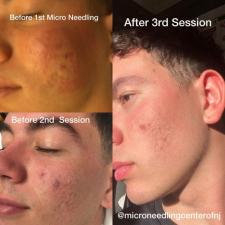 Before after microneedling 010