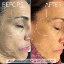 Before after microneedling 011