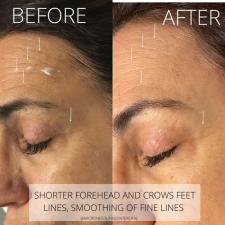 Before after microneedling 012