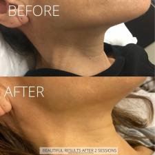 Before after microneedling 013