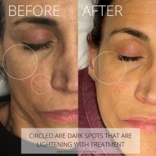 Before after microneedling 014