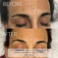 Before after microneedling 015