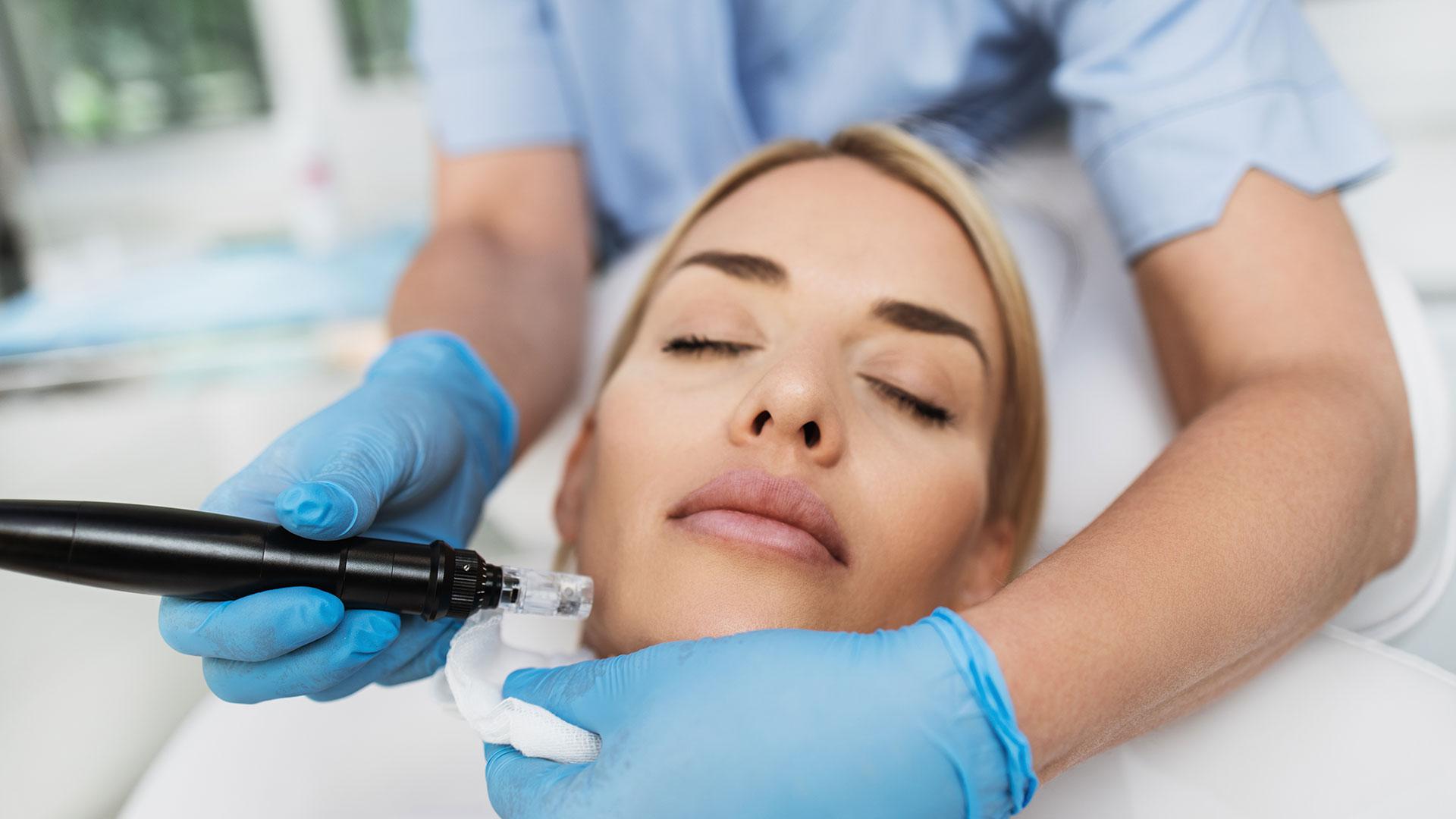 micro needling process