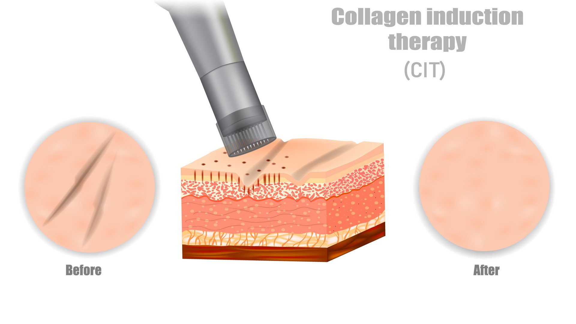 what is micro needling