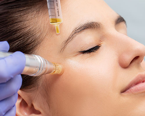 micro needling treatments