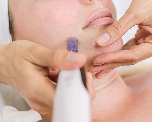 micro needling treatments