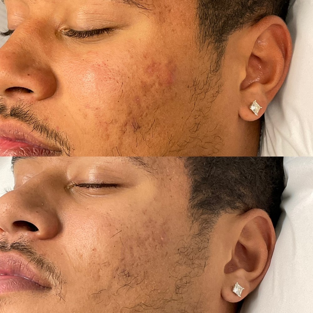 Exceptional Microneedling Treatment for Acne in Paramus, NJ