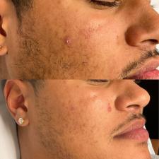 Microneedling treatment for acne paramus nj week3 left side 1